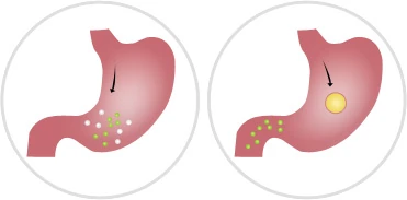 Comparación de siluetas antes y después del uso de Silvets.